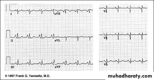 2 THE 12 LEADS STNDARD ECG
