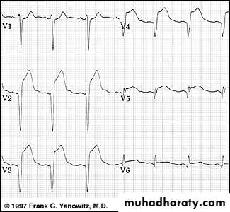 2 THE 12 LEADS STNDARD ECG
