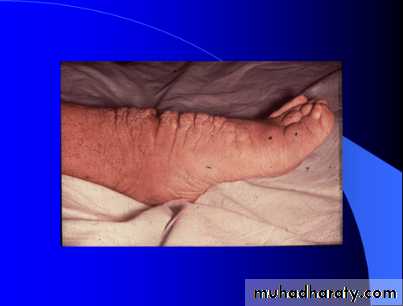 Hyperthyroidism