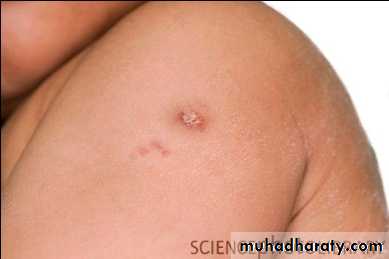 Vaccination and specific types of vaccines