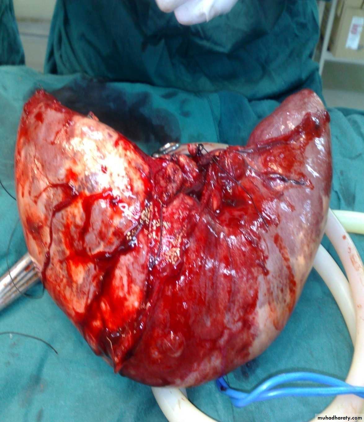 pediatric surgery