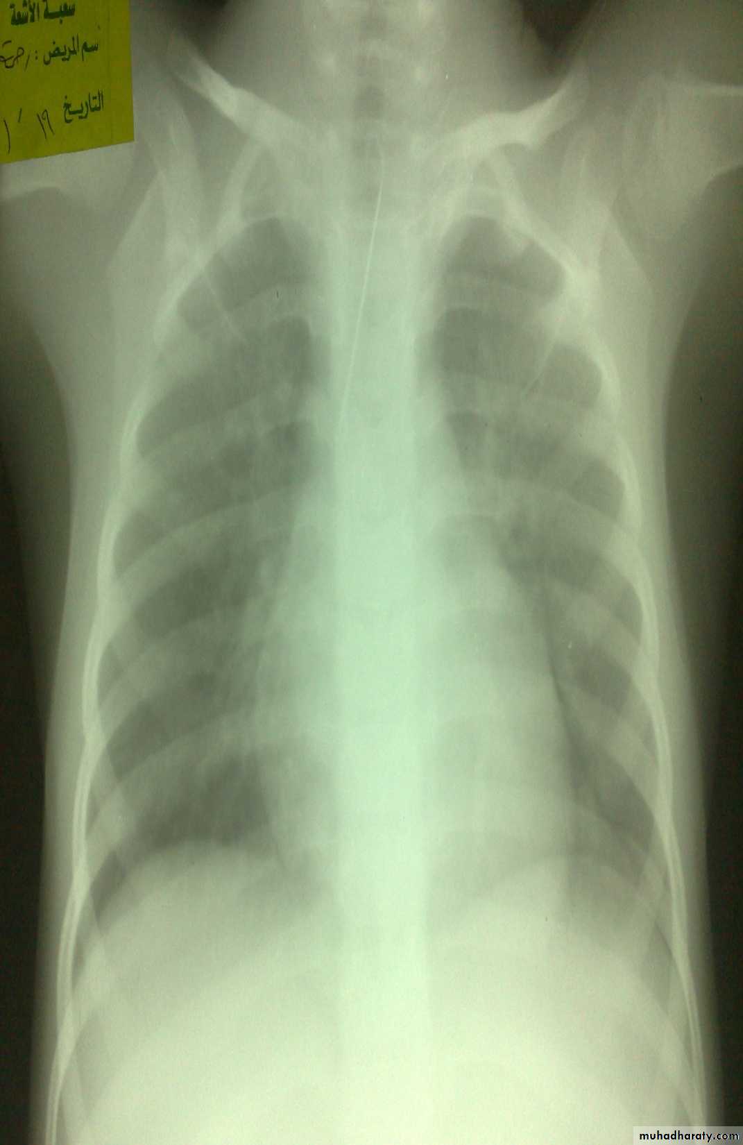 pediatric surgery