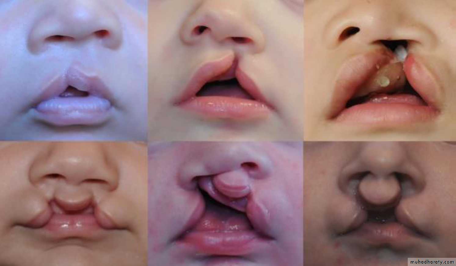 pediatric surgery