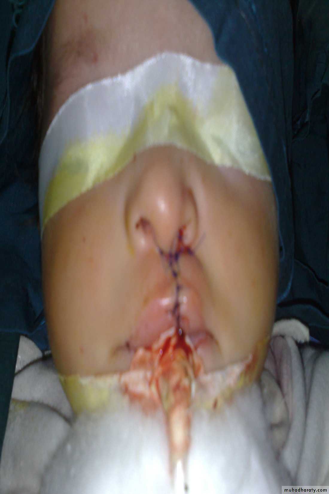 pediatric surgery