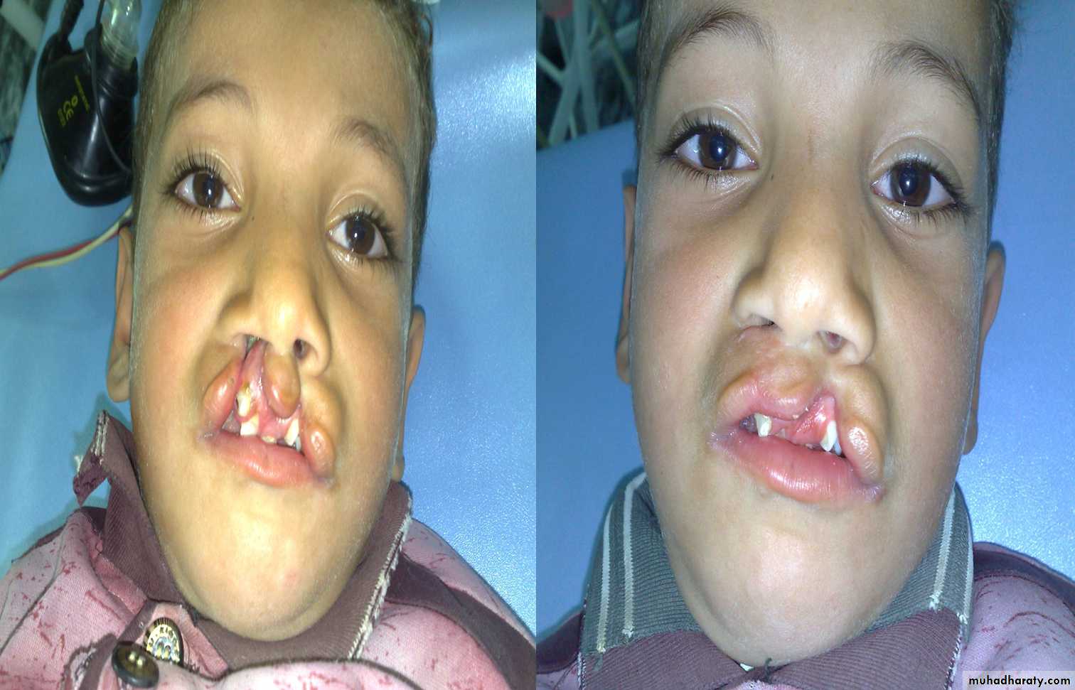 pediatric surgery