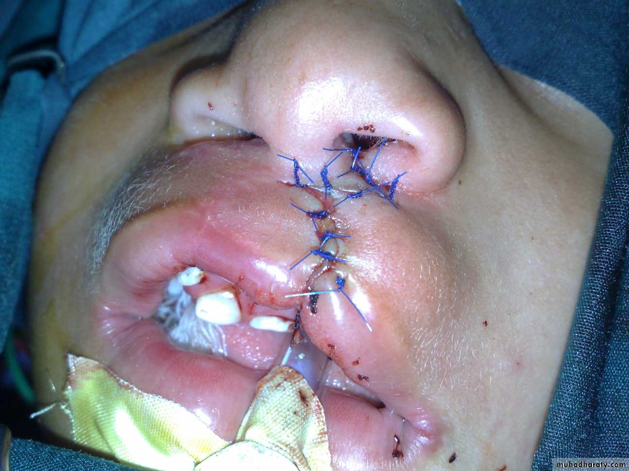 pediatric surgery