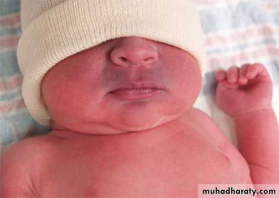 neonatal exam