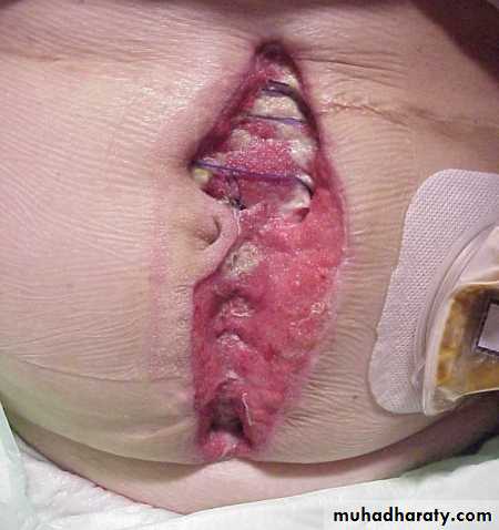 Abdominal wall
