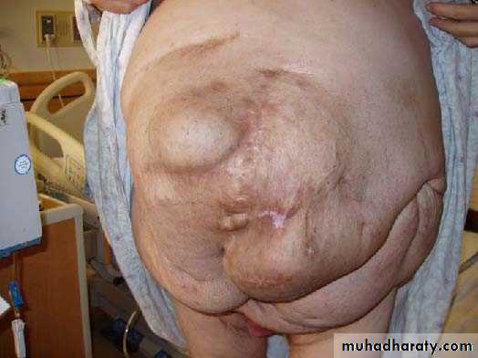 Abdominal wall