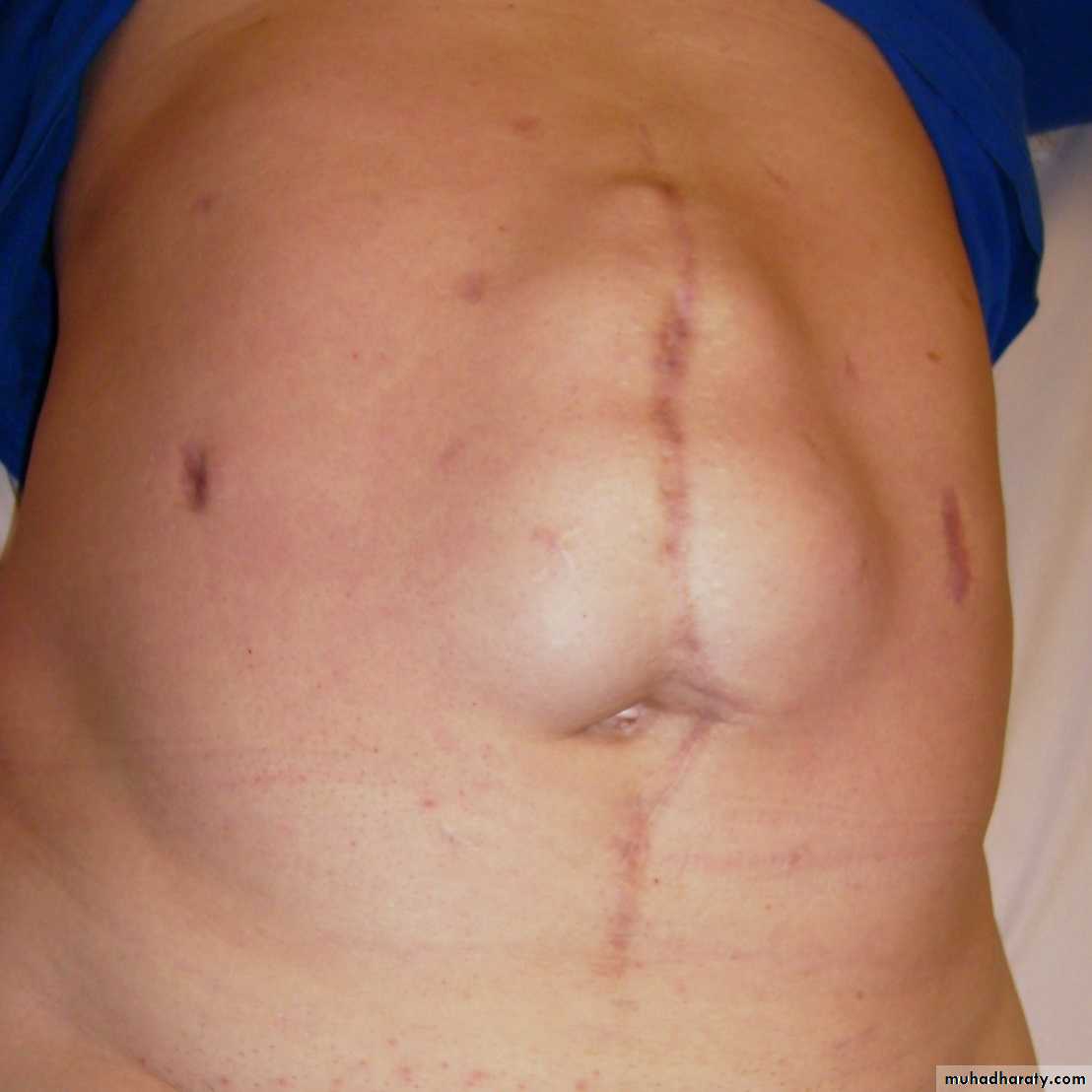 Abdominal wall