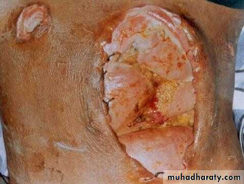 Abdominal wall