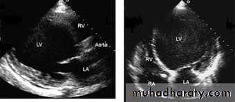 Diseases of the myocardium