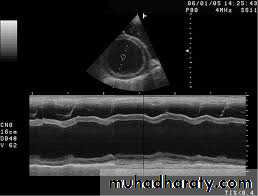 Diseases of the myocardium
