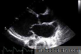 Diseases of the myocardium