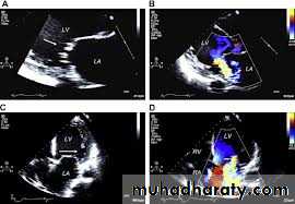 Diseases of the myocardium