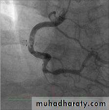 Diseases of the myocardium