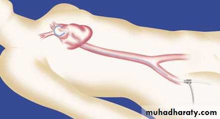 Diseases of the myocardium