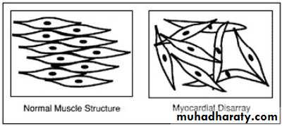 Diseases of the myocardium