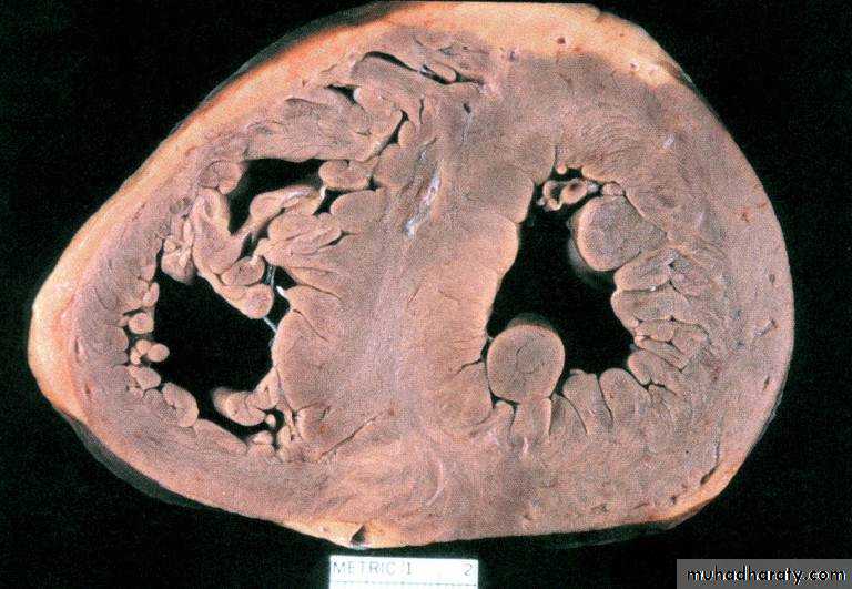 Diseases of the myocardium