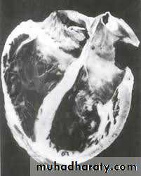 Diseases of the myocardium