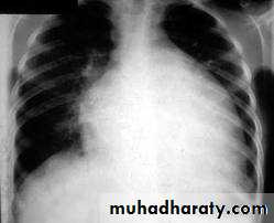 Diseases of the myocardium