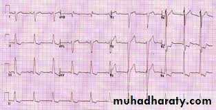 Diseases of the myocardium