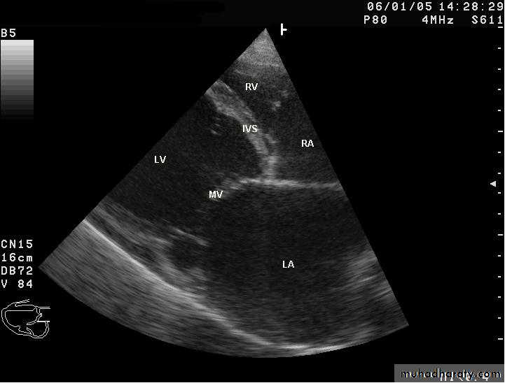 Diseases of the myocardium