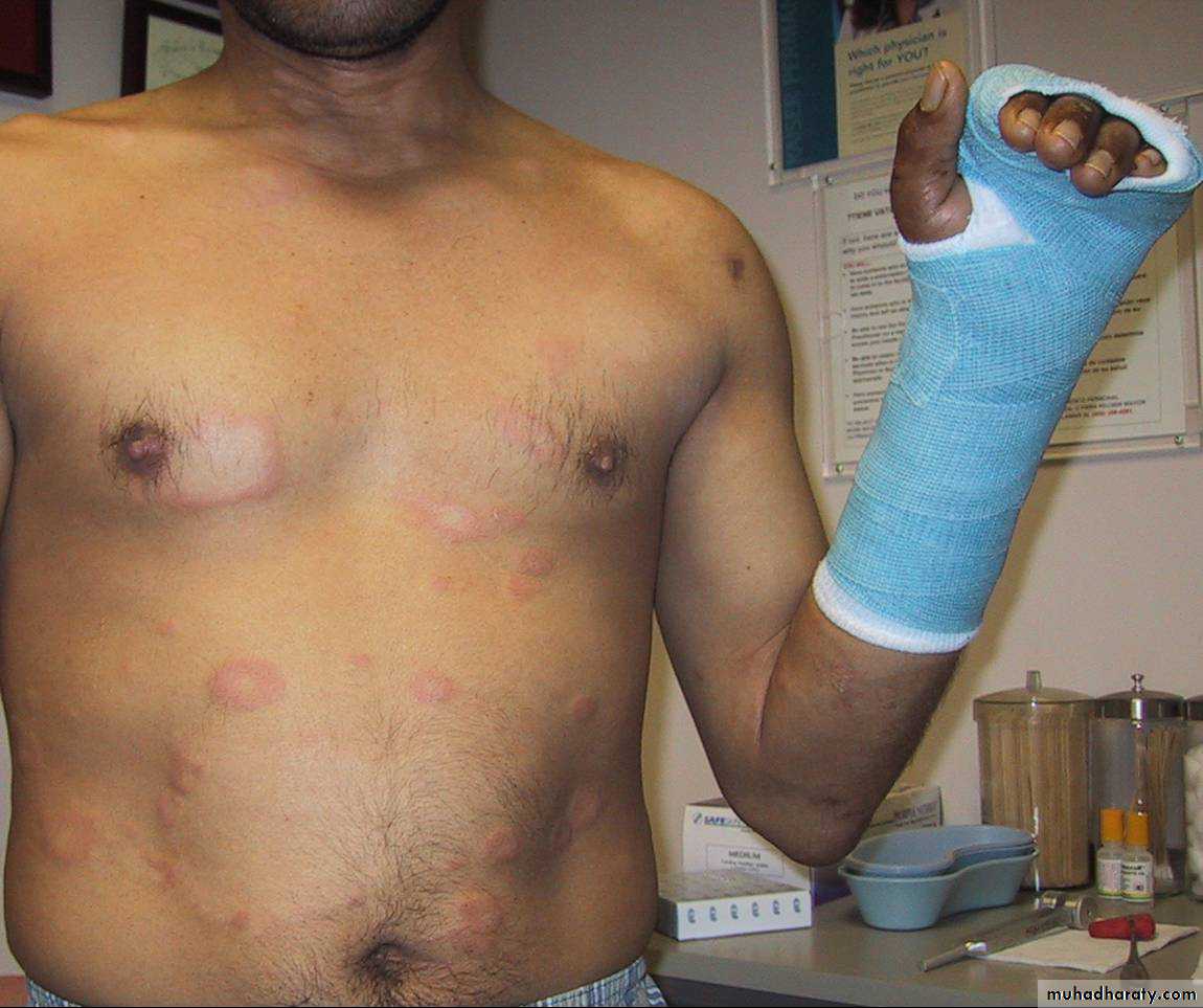 Leprosy