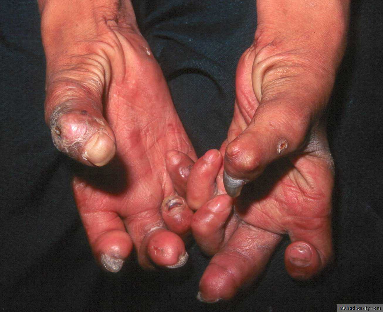 Leprosy