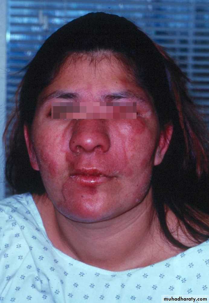Leprosy