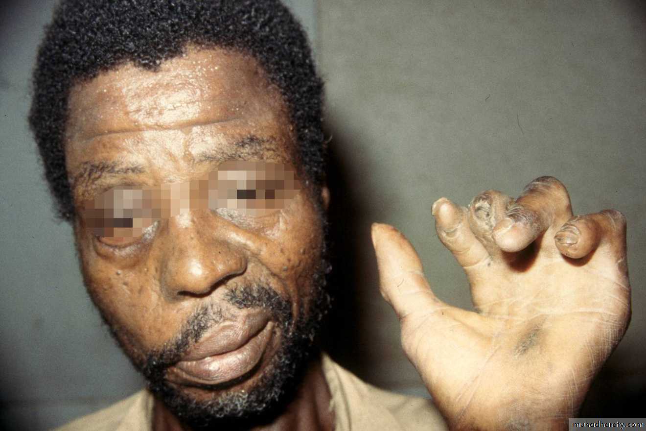 Leprosy
