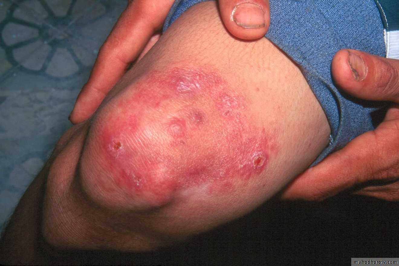 Leprosy