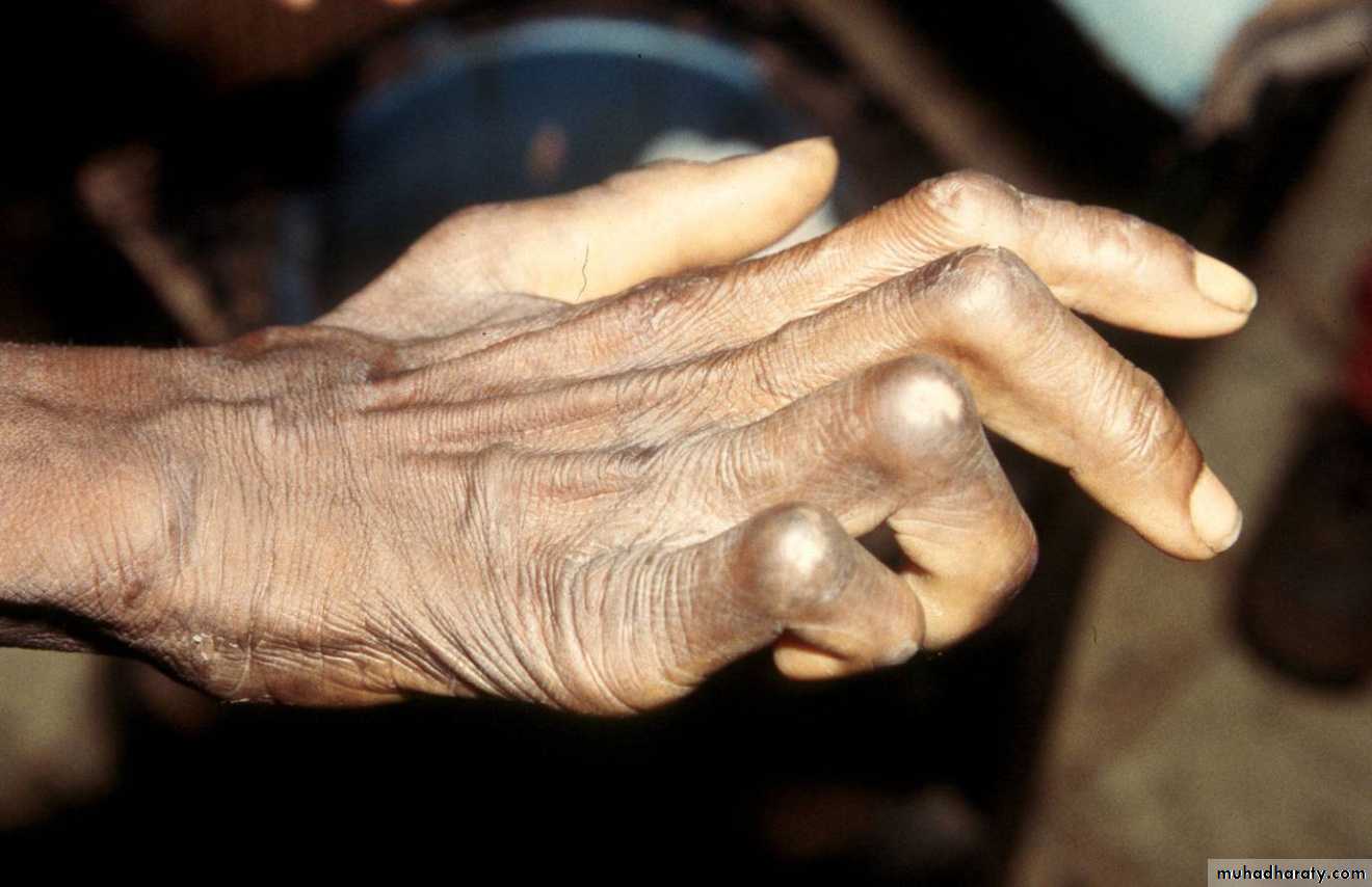 Leprosy