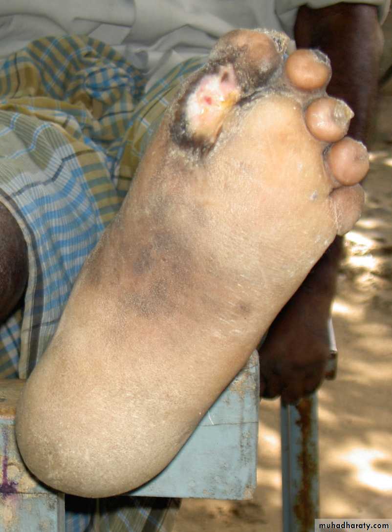 Leprosy