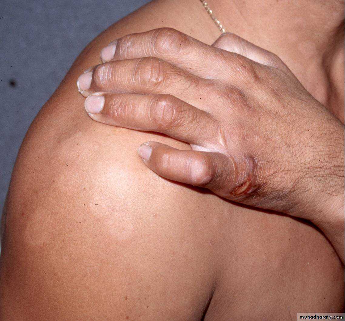 Leprosy
