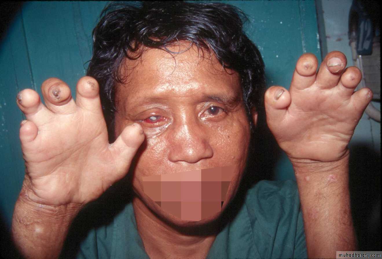 Leprosy
