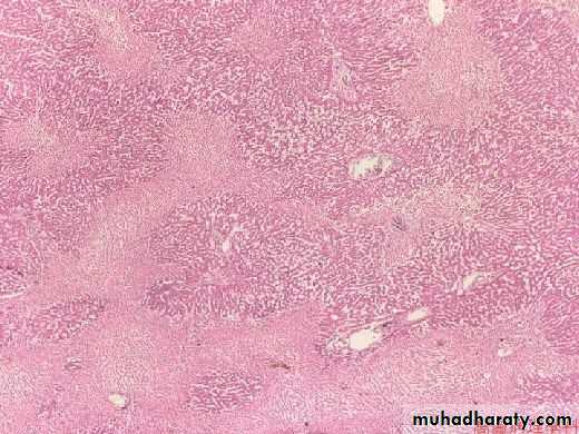 Patterns of hepatic injury