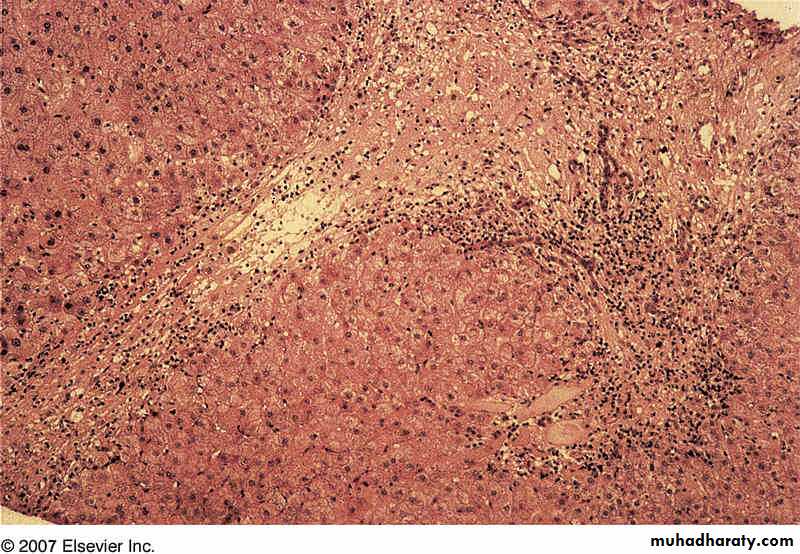Patterns of hepatic injury