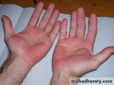 Acute liver failure