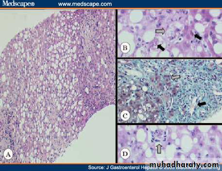 Alcoholic liver disease and Nonalcoholic fatty liver disease
