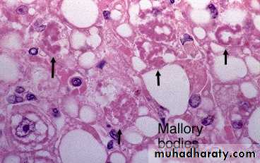Alcoholic liver disease and Nonalcoholic fatty liver disease