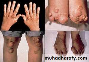 Primary biliary cirrhosis and Primary sclerosing cholangitis