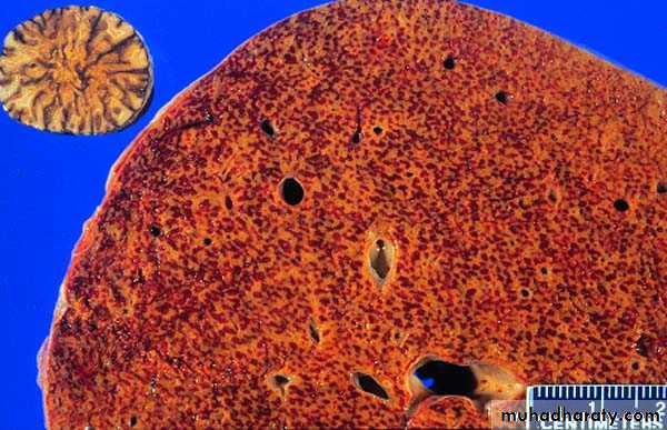 Primary biliary cirrhosis and Primary sclerosing cholangitis