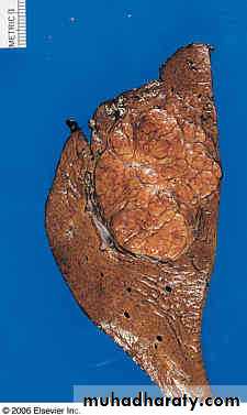 Nodules and Tumors of the liver