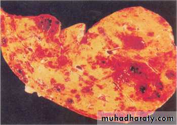 Nodules and Tumors of the liver