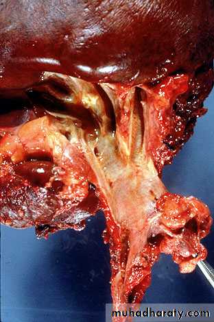 Nodules and Tumors of the liver