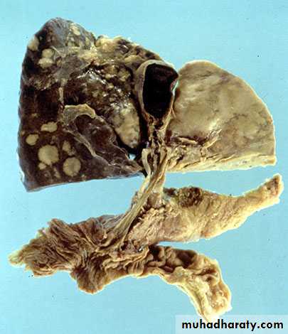 Nodules and Tumors of the liver