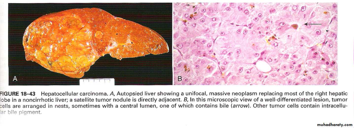Nodules and Tumors of the liver