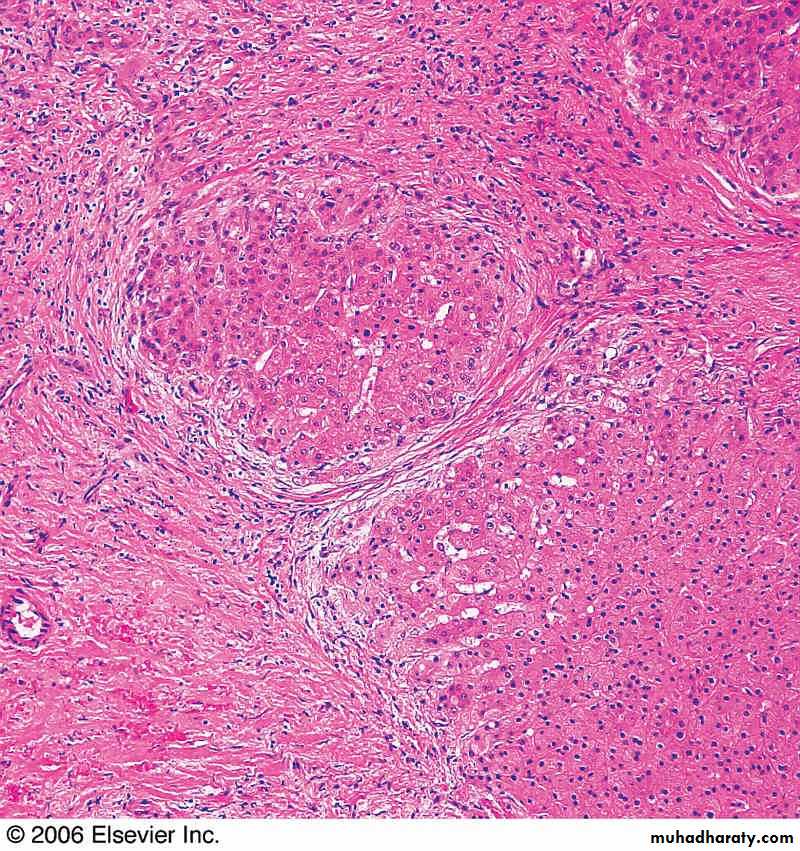 Nodules and Tumors of the liver