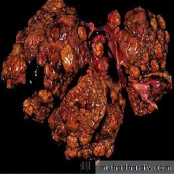 Nodules and Tumors of the liver
